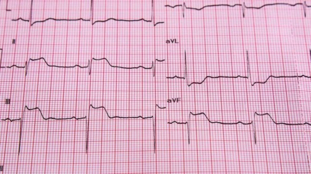 Common Heart Tests | Dr Michael MacDonald Singapore