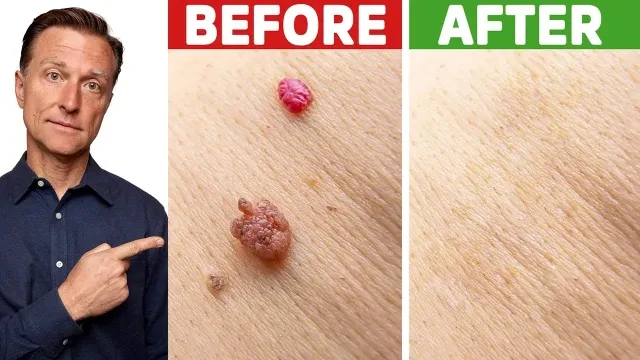 How to Rid Skin Tags and Warts OVERNIGHT