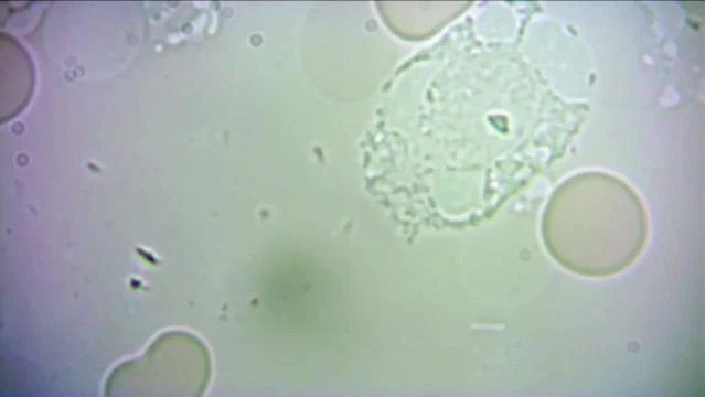 WBC Eryptosis & Uric Acid & Wipeout